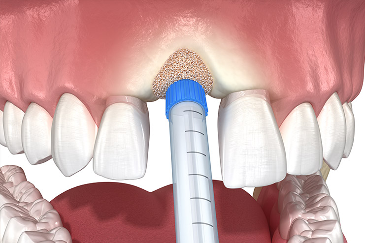 Dental bone grafting example Dental bone grafting example