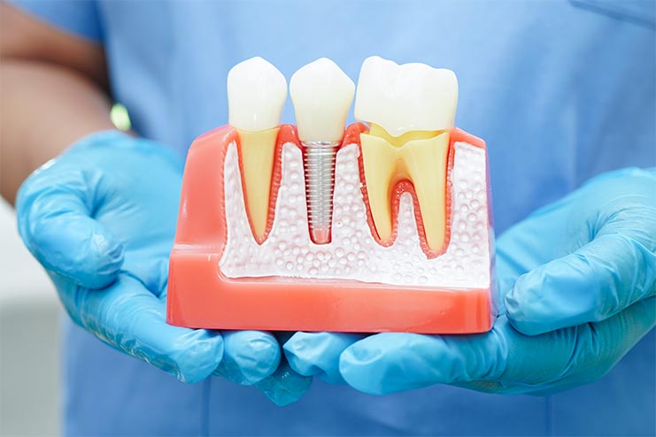 dental-implants-example Model of dental implants
