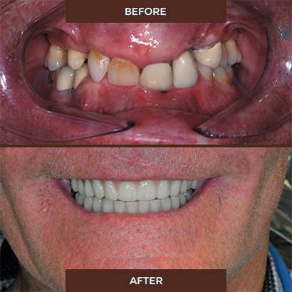 Dental implants before and after Dental implants before and after