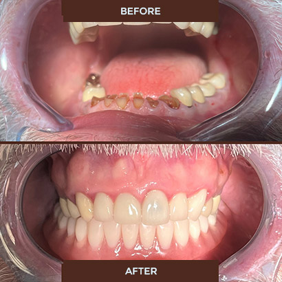 Lower overdenture before and after Lower overdenture before and after